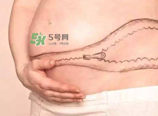 剖腹產疤痕怎么去除？剖腹產疤痕能去掉嗎？