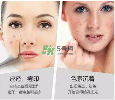 果酸換膚自己可以做嗎？果酸換膚后注意事項