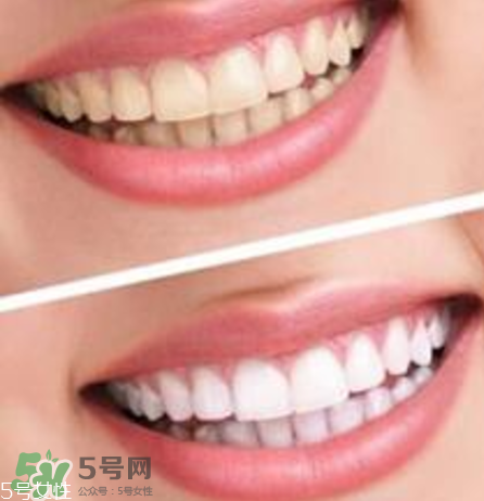 碧緹福美牙儀對牙齒有傷害嗎？碧緹福美牙儀會反彈嗎？