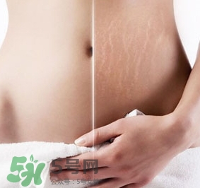 妊娠紋什么時候變白？妊娠紋產品什么時候用？