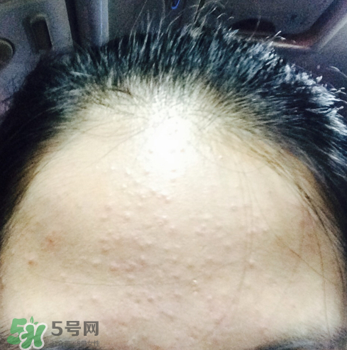 長痘長閉口怎么辦？長痘長閉口是什么原因？