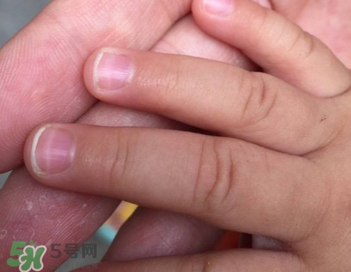 寶寶手指甲有白痕怎么回事？幼兒手指甲發白是缺鈣嗎