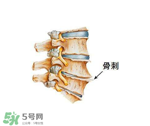 骨刺是怎么形成的？骨刺怎么治療？