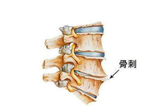 骨刺是怎么形成的？骨刺怎么治療？