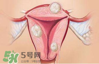 雙子宮可以上環嗎？雙子宮上環要注意哪些？