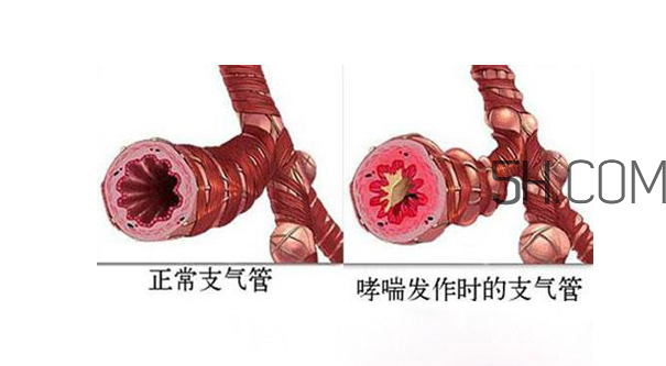 哮喘應該看什么科?哮喘應該吃什么藥?