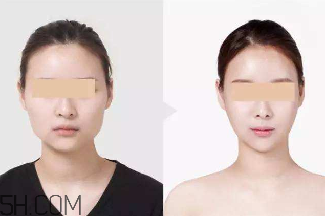 打瘦臉針可以抽煙嗎？打瘦臉針會反彈嗎？