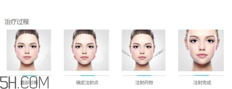 打瘦臉針可以抽煙嗎？打瘦臉針會反彈嗎？