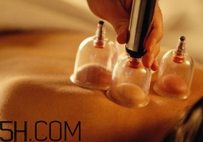 拔罐可以治療鼻炎嗎？鼻炎拔罐拔哪里？