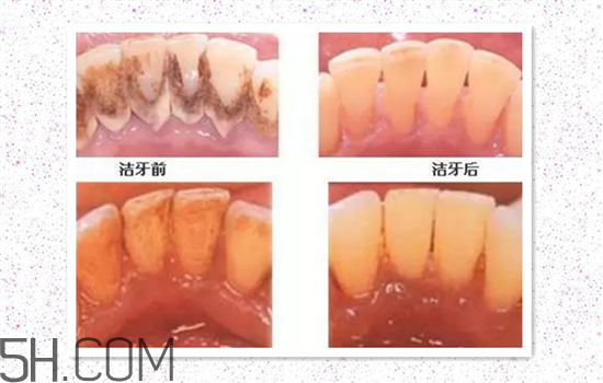超聲波洗牙可以美白牙齒嗎？超聲波洗牙多少錢一次？