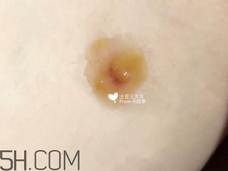 美寶濕潤燒傷膏怎么樣？美寶濕潤燒傷膏有用嗎？