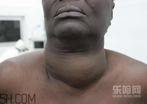 甲狀腺腫大和甲亢的區(qū)別有哪些？甲狀腺腫大適合吃什么食物？