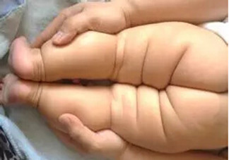 寶寶腿紋不對稱是怎么回事？嬰幼兒的生長發育標準是怎樣的？
