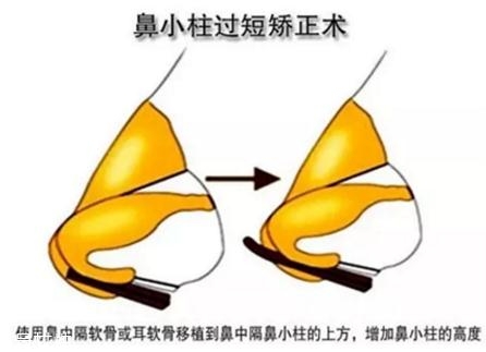 鼻小柱延長用什么材料？優先選擇鼻中隔軟骨