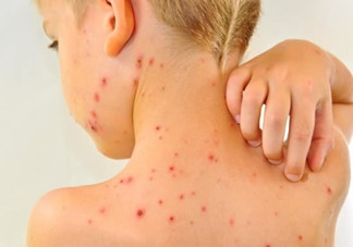 水痘有何傳播途徑？多發于春秋季
