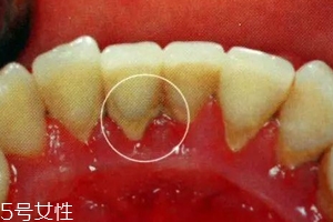 牙結石能自動脫落嗎？除了洗牙別無他法