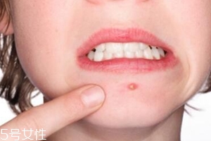 肌膚需要排毒嗎？長(zhǎng)痘并不代表排毒