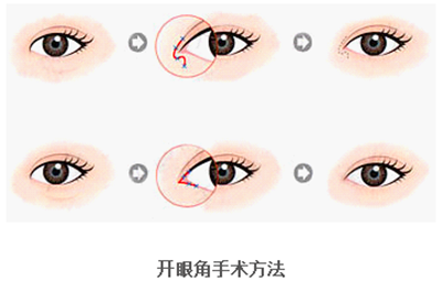 開眼角疤痕多久消失？開眼角的適宜人群