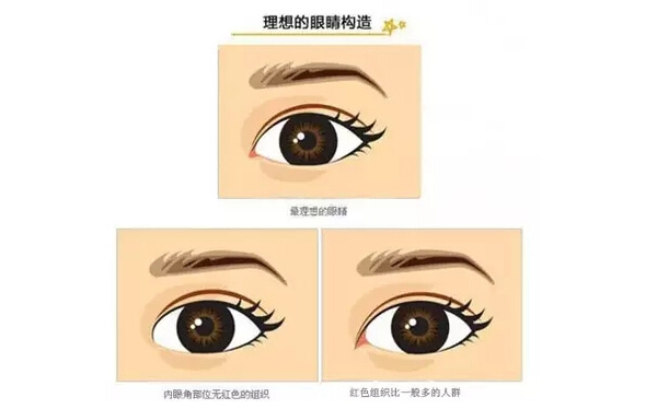 開外眼角和開內眼角哪個好？開眼角有可能會回縮