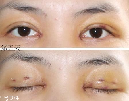 怎么縮短開眼角疤痕消失時間？雙眼皮開眼角恢復(fù)過程