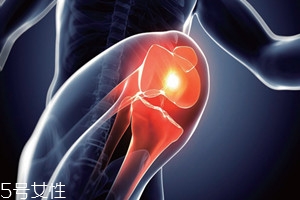 膝骨關節炎有什么癥狀 需注意5大癥狀