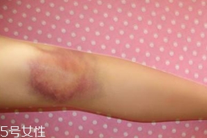 身體淤青怎么來的？不是磕碰那么簡單