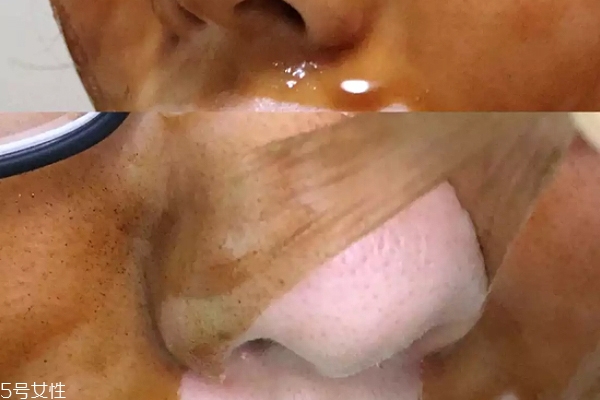 雪花秀撕拉面膜怎么撕出黑頭？這么做才能去黑頭