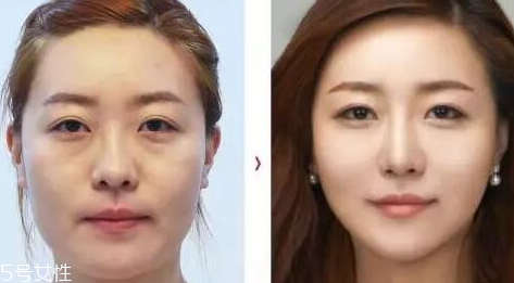 臉上出現三八紋怎么去除 抗老要提前