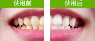 牙貼怎么分上下牙貼？牙貼怎么分正反