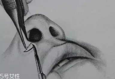 鼻翼外切多久消腫？鼻翼外切消腫時(shí)間要多長(zhǎng)？