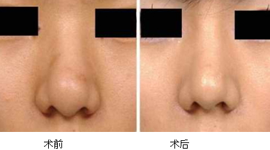 縮鼻手術多久恢復？縮鼻手術傷口才會好