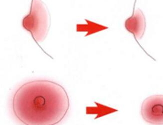 乳暈縮小術全千萬別做 乳暈縮小術不宜人群