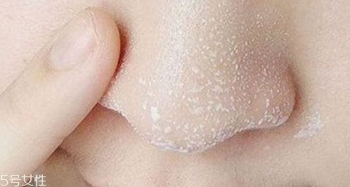 黑頭不管它會變大嗎？黑頭不管它會怎樣？