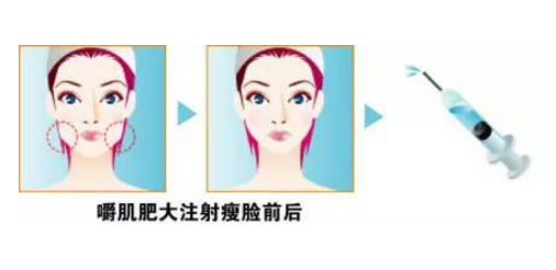 溶脂針和瘦臉針哪個貴 溶脂針和瘦臉針區別