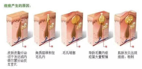 頑固痘痘怎么消除？油皮為什么反復(fù)爆痘？