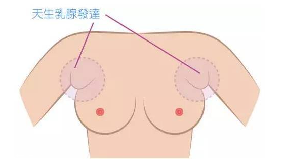 假副乳和真副乳的區別 前者能快速消除