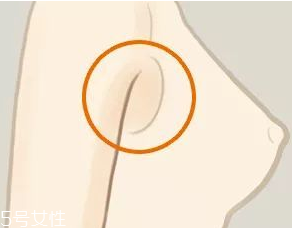 假副乳和真副乳的區別 前者能快速消除