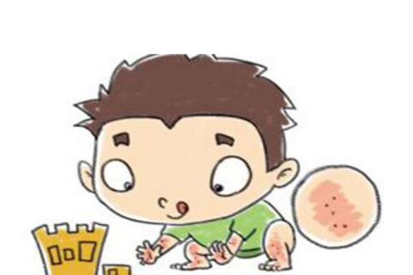 神經性皮炎是什么 怎么護理