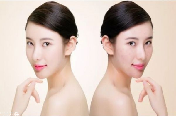 女人25歲后怎么保養皮膚 皮膚衰老的三個階段