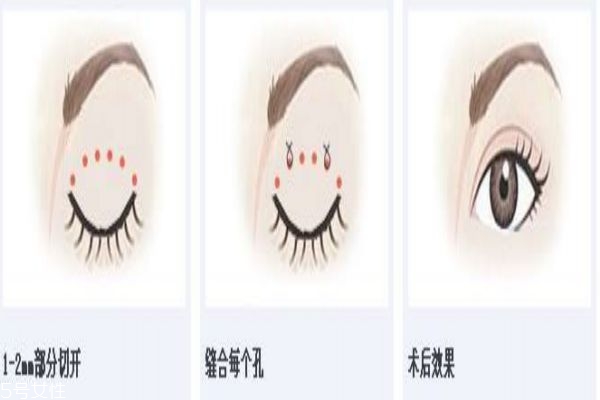 韓式三點雙眼皮的缺點 韓式三點雙眼皮的優勢