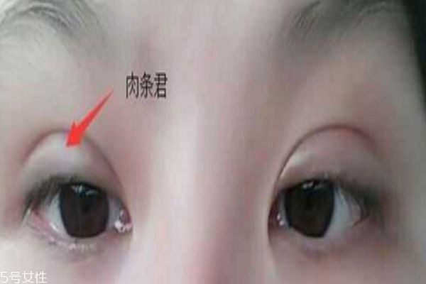 全切雙眼皮肉條和腫的區別 有肉條的原因