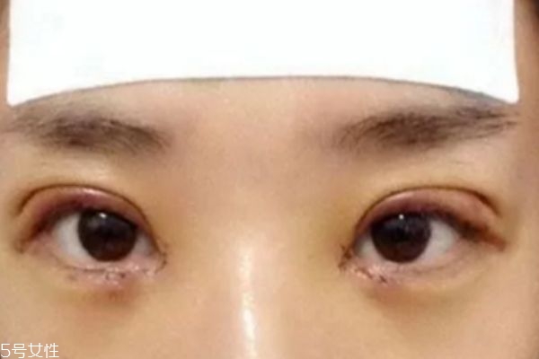 全切雙眼皮肉條和腫的區別 有肉條的原因