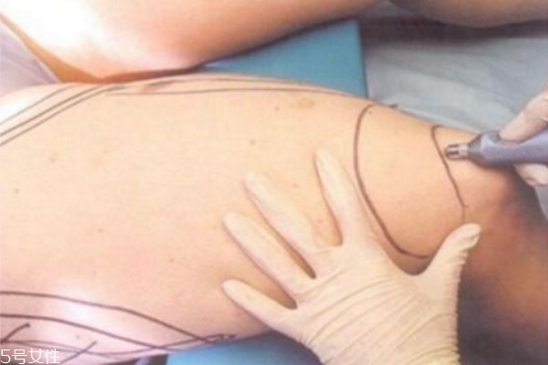 大腿環形吸脂多久完全消腫 抽脂瘦腿有哪些后遺癥