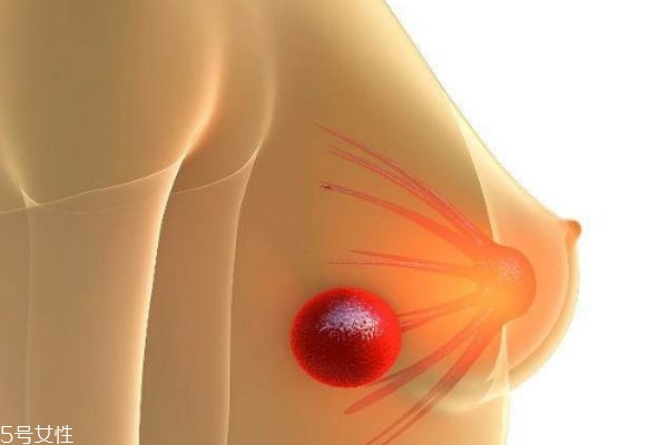 乳腺結節可以消除嗎 什么樣的乳腺結節屬于乳腺癌
