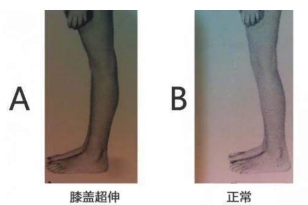 膝關節超伸的表現 快來自測一下把
