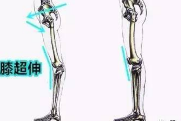 膝關節超伸的表現 快來自測一下把