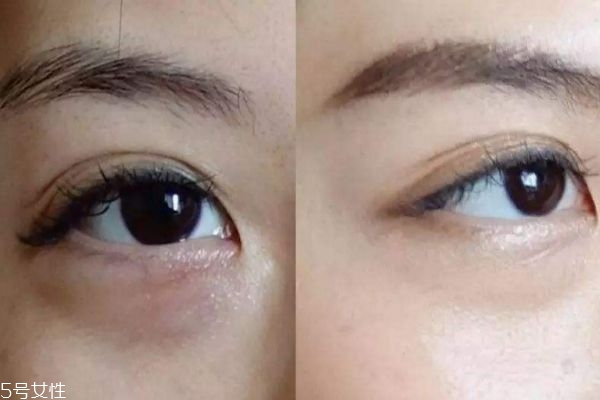 眼袋內切好還是外切好 去眼袋內切和外切區別