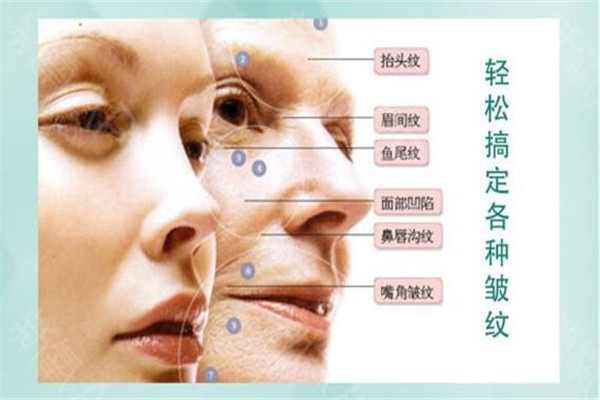 肉毒素有副作用嗎 怎么保養好