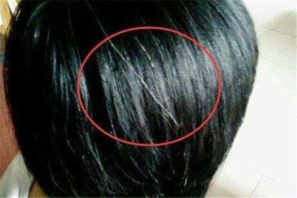 白頭發可以染色嗎 白頭發的治療