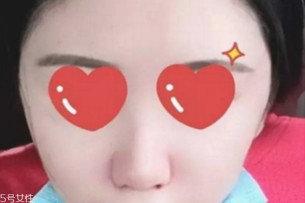 鼻翼內切是切鼻基底嗎 鼻翼內切效果圖